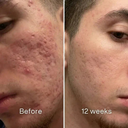 Plunne ™ Acne Scar Invisible Repair Stick