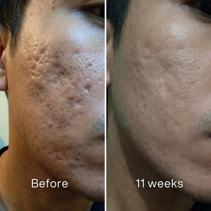 Plunne ™ Acne Scar Invisible Repair Stick